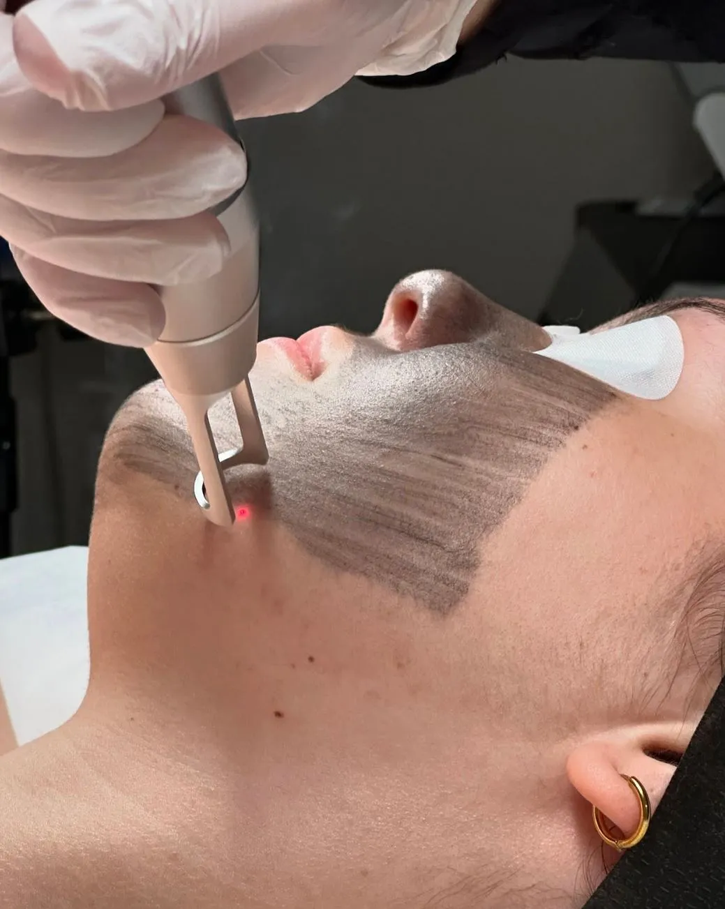 How Often Should You Get a Carbon Laser Facial