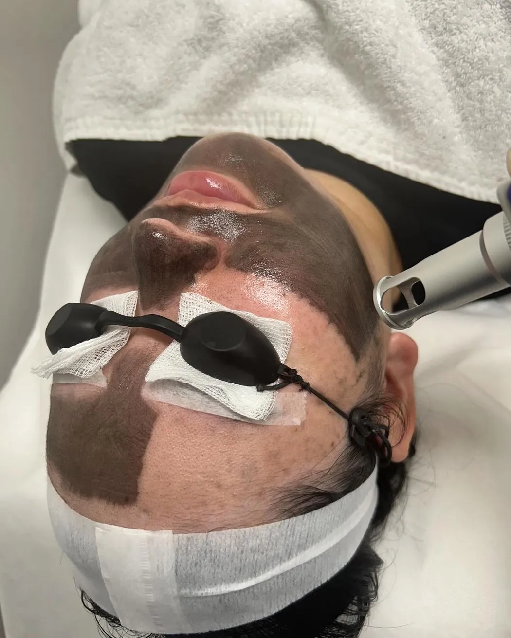 Viking Vear | How Often Should You Get a Carbon Laser Facial? What Results Can You Expect Over Time