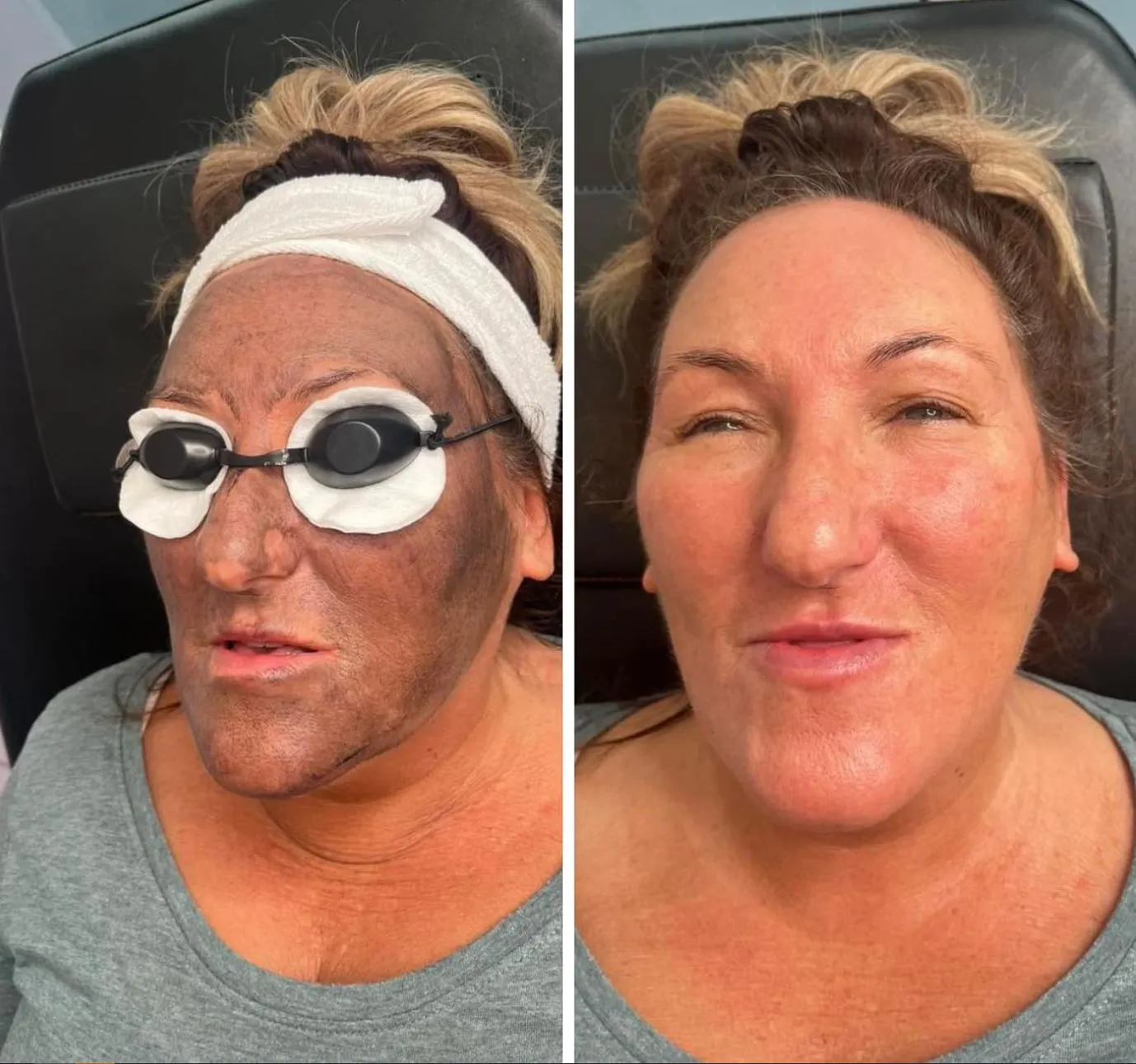 Viking Vear | How Often Should You Get a Carbon Laser Facial? Why This Facial Has a Bit of a Cult Following