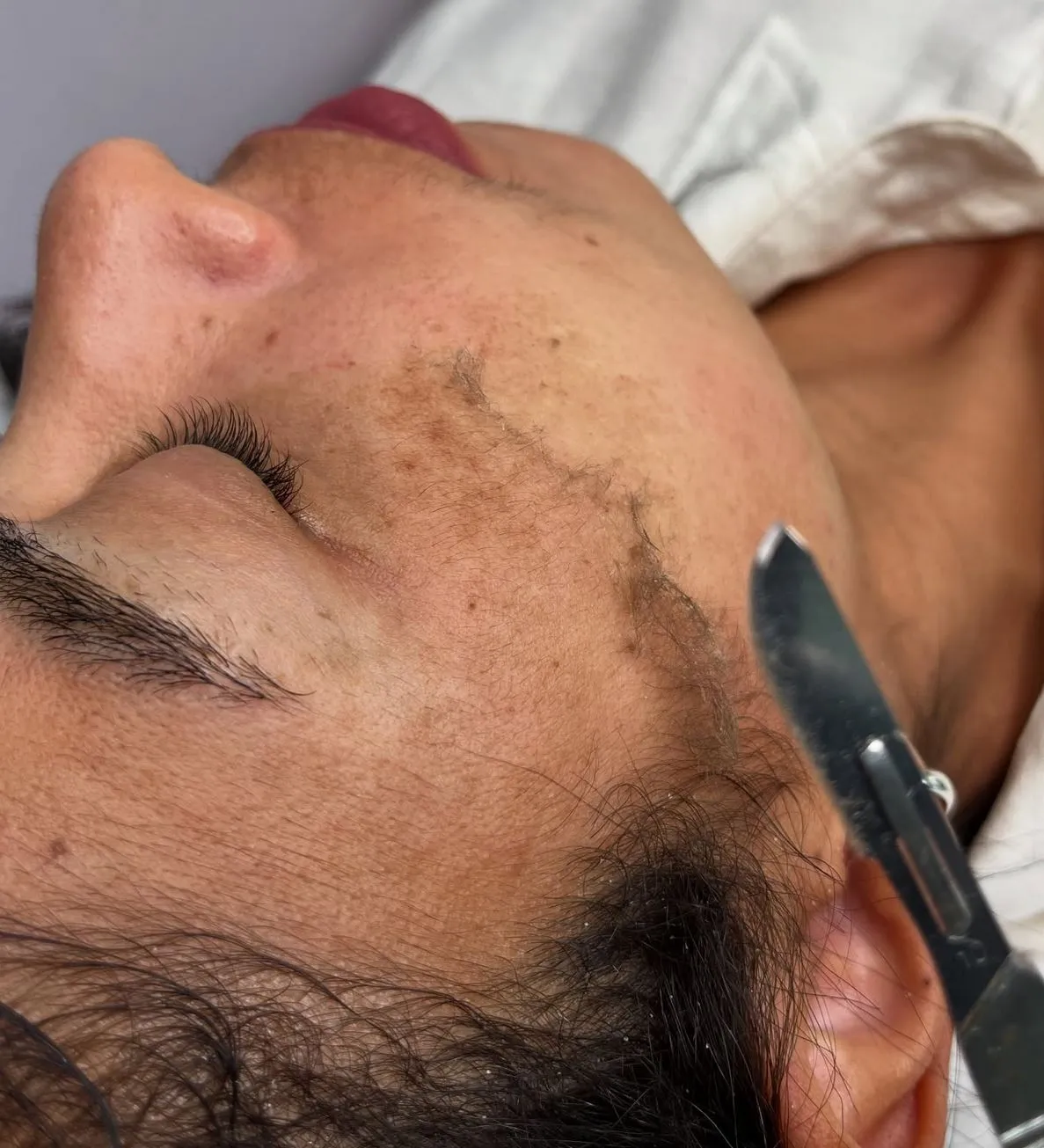 dermaplaning Brisbane