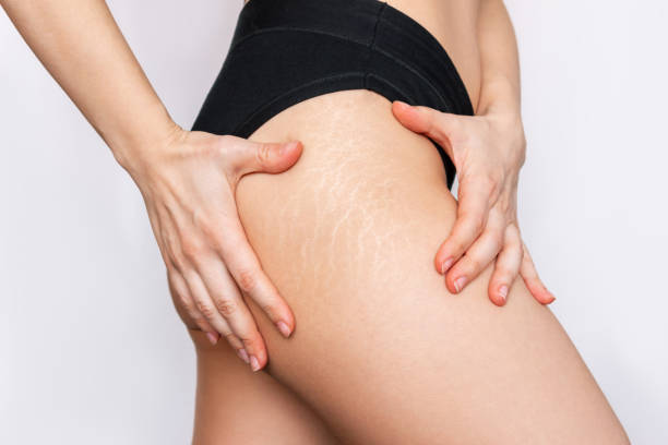 Close-up of a woman examining stretch marks on her thigh