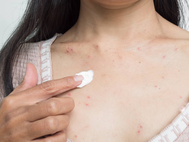 Woman applying cream on acne on her chest