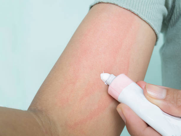 Person applying cream to a skin rash on their arm.