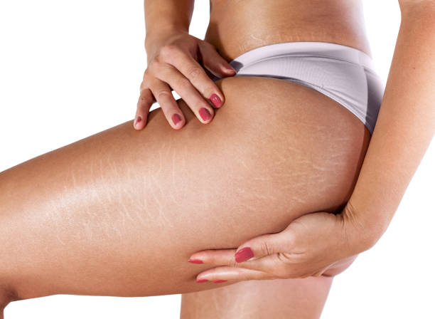 Close-up of woman showing stretch marks on thigh