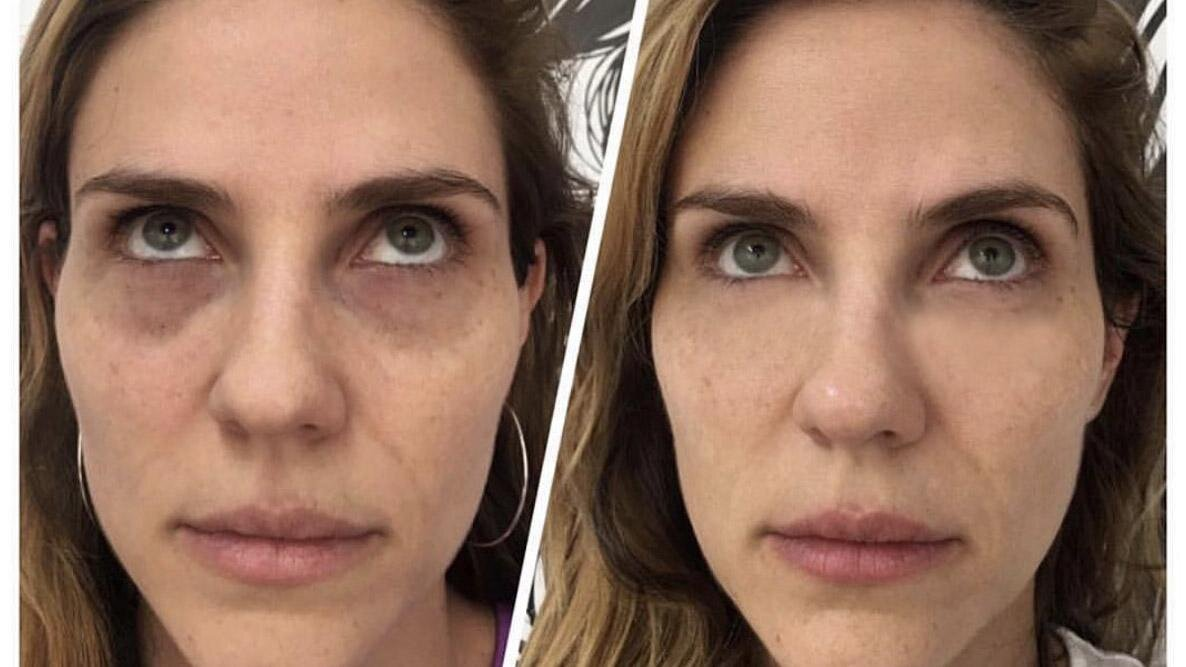 Natural ways to plump under eyes without filler using facial massage techniques